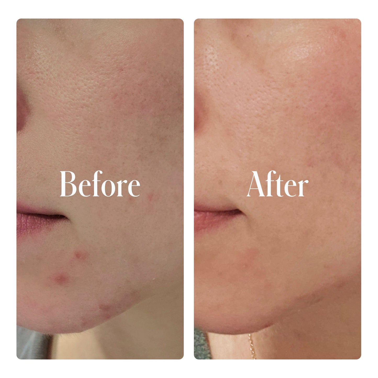 Award-Winning Geologie Clear Skin System Before and after comparison of skin with visible improvements on a person's face.