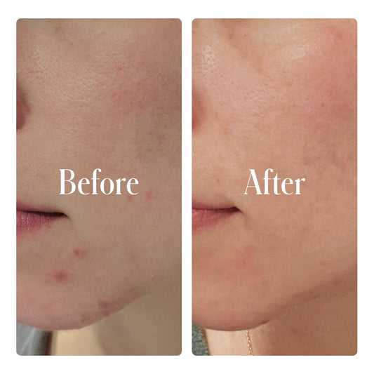 Award-Winning Geologie Clear Skin System Before and after comparison of skin with visible improvements on a person's face.