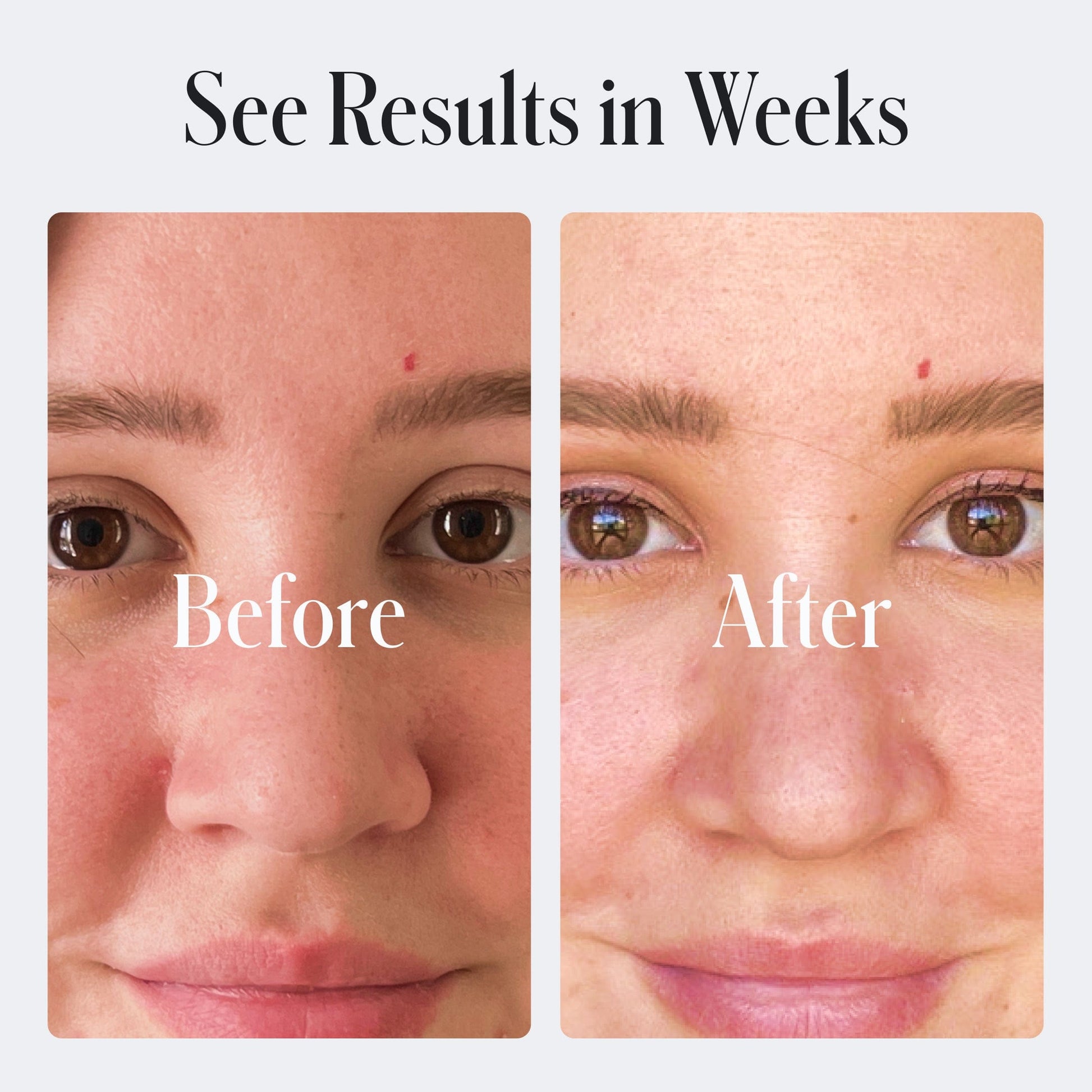 Before and after comparison of a face using Clear Skin Repair Moisturizer with text 'See Results in Weeks' above.